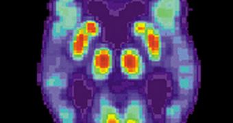 This PET scan shows the brain activity of a typical Alzheimer's patient