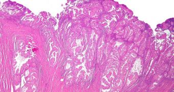This micrograph shows the endometrial cancer