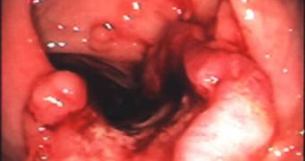 An endoscopic image of colon cancer
