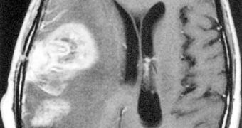 Tumor revealed by brain MRI