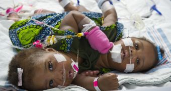 Surgeons manage to separate conjoined twins