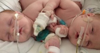Dcotors in Texas successfully separate conjoined twins