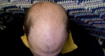 Baldness causes much discomfort among middle-aged men worldwide