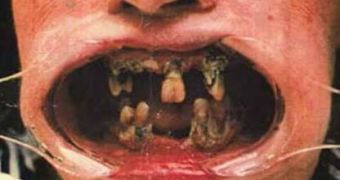 Rotting teeth caused by methamphetamine use