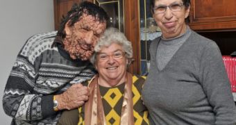 Vinicio Riva suffers from a rare disease that left him covered in painful growths