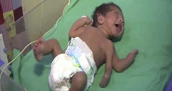 Doctors Operate on Baby Born with 3 Arms, Remove the Extra Limb