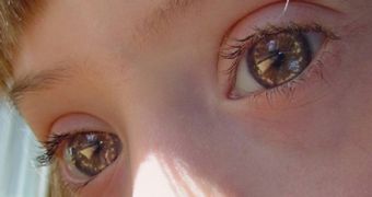 Brushfield’s Spots - white spots on the iris - are common for children suffering from Down syndrome