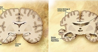 Photo shows what a brain affected by Alzheimer's (right) looks like when compared to a healthy one (left)