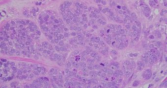 Micrograph showing high grade invasive ductal carcinoma in the breast