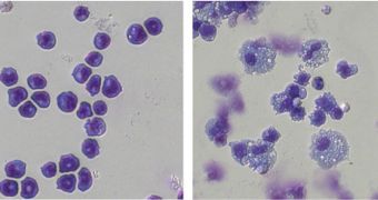 Leukemia cells (left) become less aggressive after the SWI/SNF protein complex is removed (right)