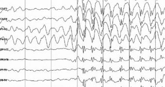 This EEG graph shows brain activity at the start of an epilepsy seizure