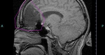 MRI of brain after surgery for Oligodendroglioma tumor