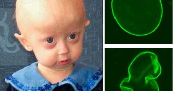 First Human Model Gives Insight on Hutchinson-Gilford Progeria Syndrome