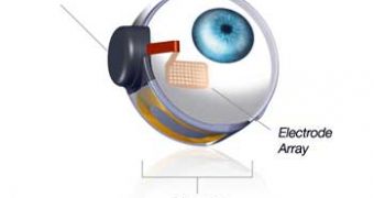 The FDA approves the use of a retinal implant to treat people suffering with rare genetic eye disease