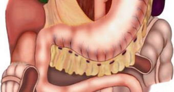 Gastric Bypass in Teens Makes Kids Suffer from Defects