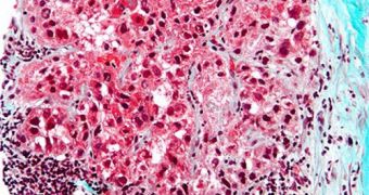 This micrograph shows hepatocellular carcinoma, which may be triggered by the presence of HVC