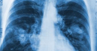 Gene driving the development of aggressive lung cancer found