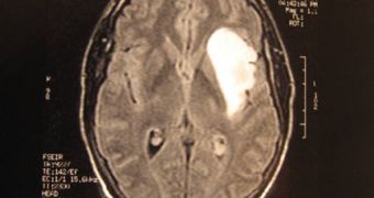 Experts identify new pointer for determining brain cancer risk in patients
