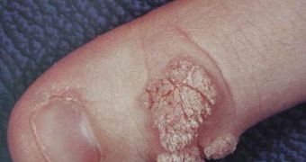 Warts on a finger