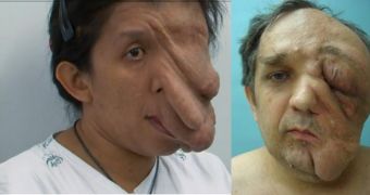 Savipat Kemkajit Chotpintu and Ed Port both suffer from Neurofibromatosis