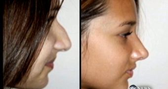 Nicolette Taylor, 13, got a nose job because of bullying: before and after