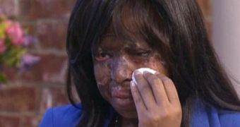 Naomi Oni after the horrible acid attack