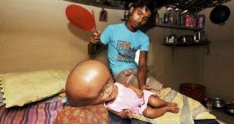 15-month-old Roona Begum has undergone surgery for hydrocephalus