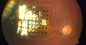 The Argus II series retinal implant, shown here inside an eye, uses an array of 60 electrodes to deliver visual information to a user's brain
