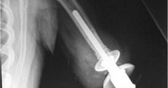 X-ray image showing a prosthetic device implanted in the arm of a woman. The actual, external prosthetic is attached to the end of the rod