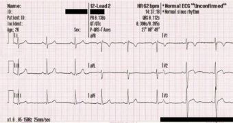 An ECG, taken from a 26-year-old man