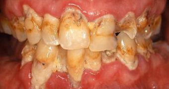 Some meth users describe their teeth as "blackened, stained, rotting, crumbling or falling apart." Often, the teeth cannot be salvaged and must be extracted