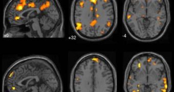 These snapshots taken from the fMRI scans show the brain regions involved in daydreaming