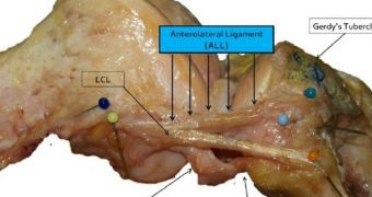 An image of a right knee after a full dissection of the anterolateral ligament (ALL)
