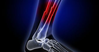 Hydrogels now said to promote the healing of bone injuries via stem cells