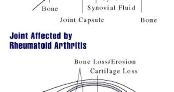 This is the difference between a normal joint and one affected by rheumatoid arthritis