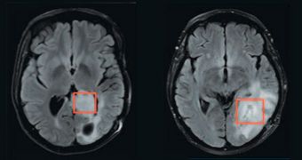 Imaging Technique Reveals the Inside of Brain Tumors