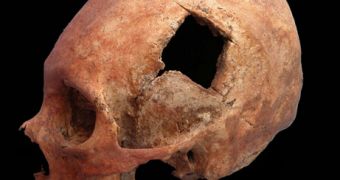 Trepanation hole on ancient Inca skull