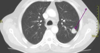 A CT scan image shows a tumor inside the patient's right lung