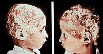 Fungus infection of the head
