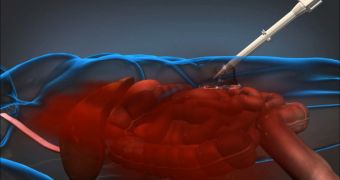 Injectable Foam Stops Internal Bleeding by Expanding Inside the Body