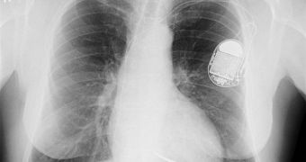 This X-ray image shows a modern pacemaker implanted in a patient. Notice its size relative to the body