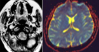 New algorithms combines fMRI (left) and dMRI (right) data, to produce a clear picture of what's going on in a patient's brain