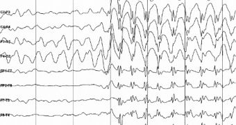 An electroencephalography (EEG) image, showing the onset of an epilepsy seizure