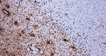 Image showing demyelination damage on neurons