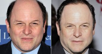 Jason Alexander, before and after the semi-permanent hair piece