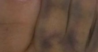 Woman says the image of Jesus appeared in a bruise on her toe
