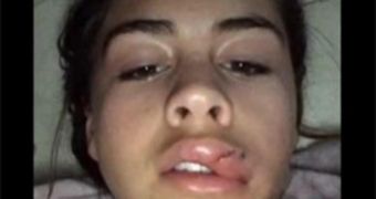 #KylieJennerChallengeGoneWrong Shows Gruesome Results of the #KylieJennerChallenge - Photo