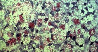 Mycobacterium leprae, stained with Ziehl-Neelsen carbolfuchsin