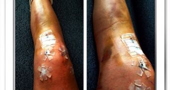 Lindsey Vonn Shows Photo of Badly Injured Leg, Pic Goes Viral