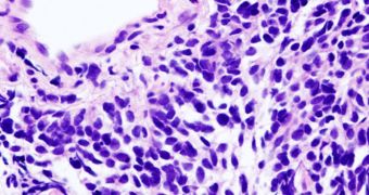 Lung Cancer Favored by Childhood History of Adversity